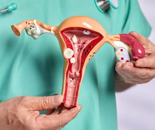 Endometriose: sintomas, causas e opções de tratamento