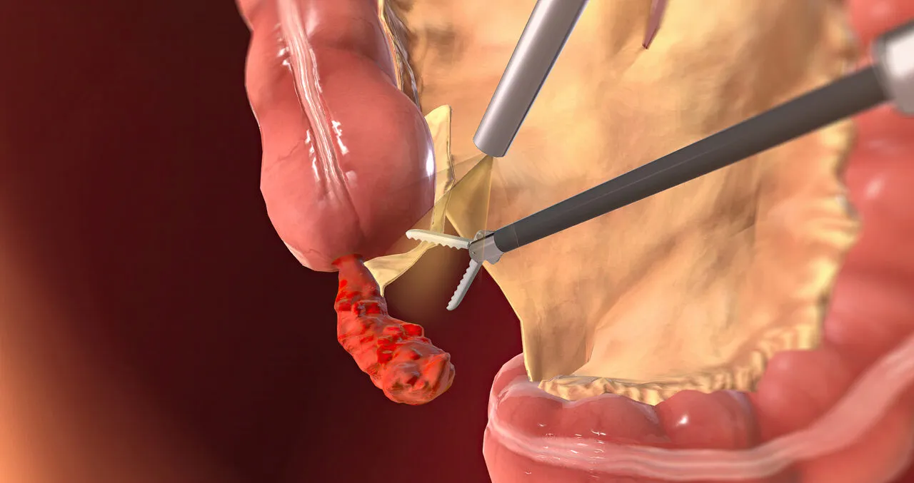 Cirurgia de Apendicite: Como É Feita e Recuperação