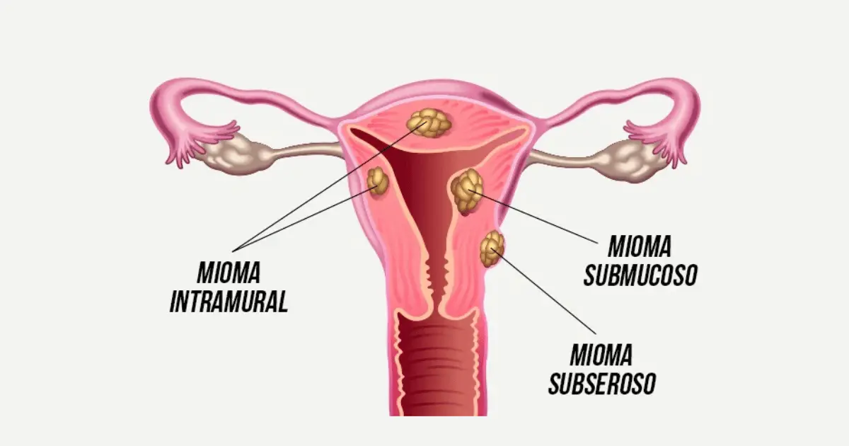 Mioma no útero: sintomas, causas e tratamentos