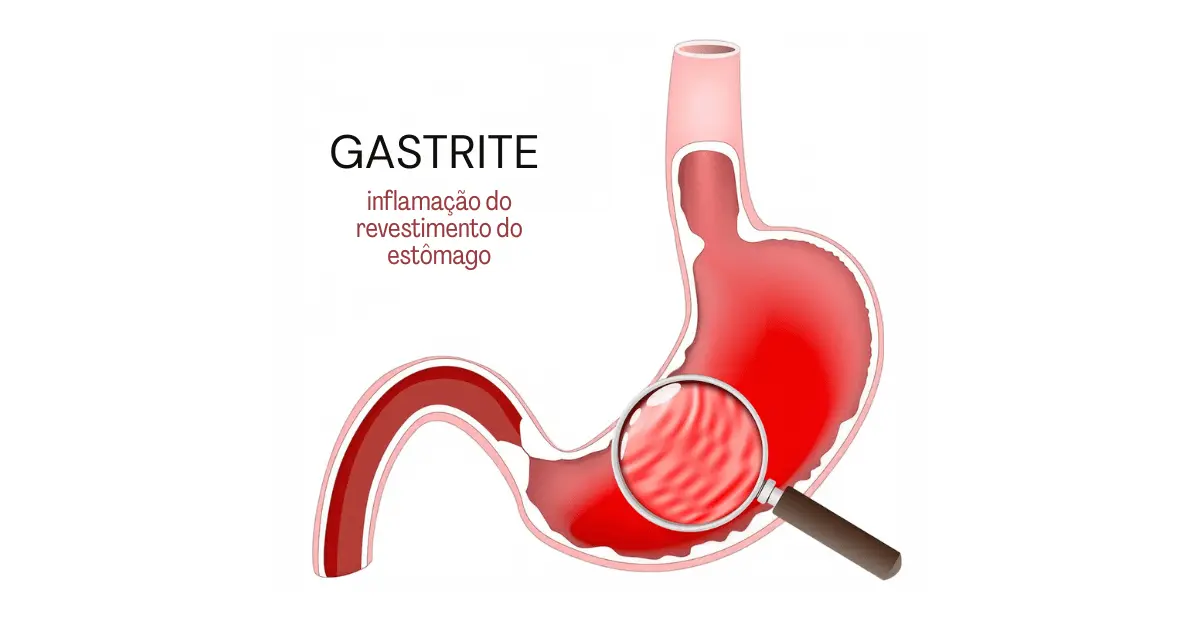 Gastrite: sintomas, causas e como é feito o tratamento